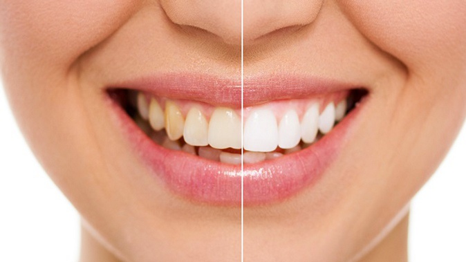 Комплексная гигиена полости рта, чистка зубов и экспресс-отбеливание или установка пломбы в стоматологической клинике «Пять звезд»
