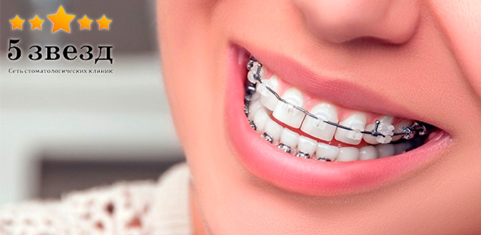 Металлические, керамические и сапфировые брекет-системы в сети стоматологий «5 звезд».
